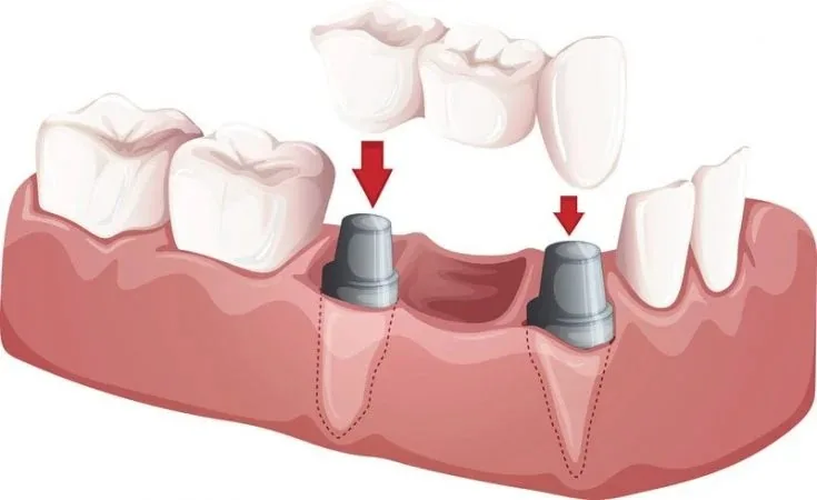 A dental bridge being fitted onto two prepared abutment teeth to replace a missing tooth.